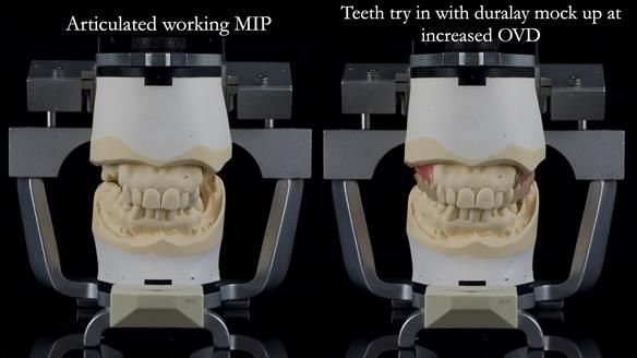 Finlay's Newsletter 60 Sylvia's upper Kennedy Class 2 Mod 1 metal based upper RPD