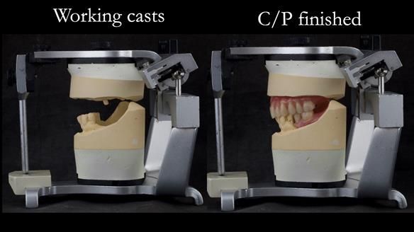 Solving Linda’s Failed “All on 4” implant bridges - full protocol Newsletter 42