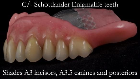 Newsletter 54 case presentation upper complete denture and lower Scandinavian designed hygienic partial denture for David