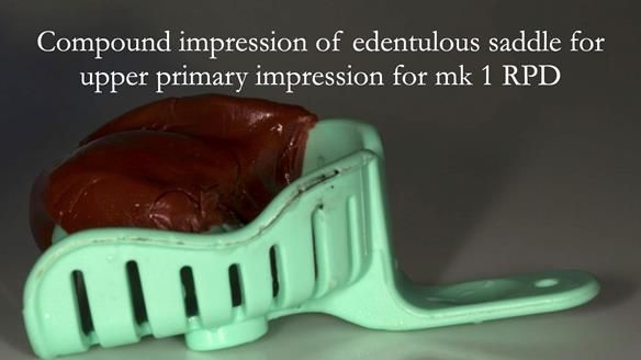 Finlay's Case Study Newsletter 40 - Immediate Mk 1 RPD to Definitive Mk 2 RPD - full protocol