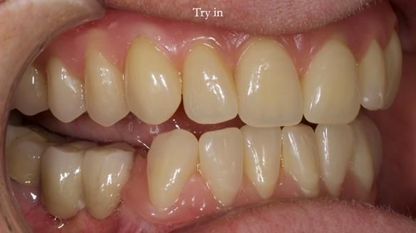 Newsletter 82 Mary - A complete upper and a one-tooth gasket denture
