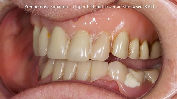 Newsletter 82 Mary - A complete upper and a one-tooth gasket denture