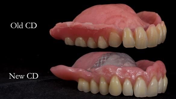 Finlay's Newsletter 62 provision of extractions and metal based complete dentures for Rafique