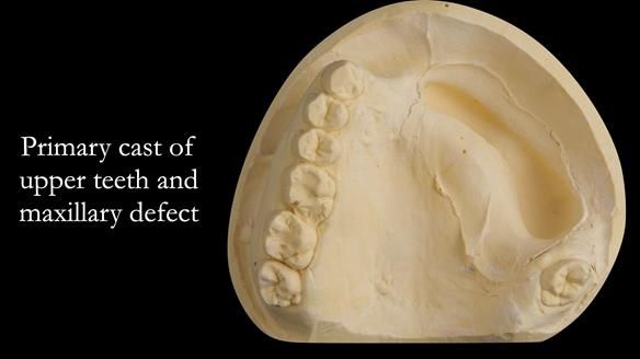 Upper metal base partial denture/occlusal stabilisation splint/obturator - full protocol