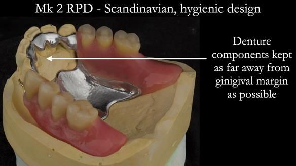 Finlay's Case Study Newsletter 40 - Immediate Mk 1 RPD to Definitive Mk 2 RPD - full protocol
