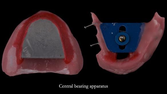 Newsletter 82 Mary - A complete upper and a one-tooth gasket denture