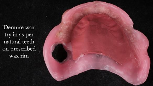 Finlay's Newsletter 58 Gasket upper partial denture for Zoe