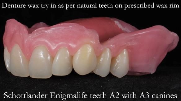 Finlay's Newsletter 58 Gasket upper partial denture for Zoe
