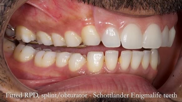 Upper metal base partial denture/occlusal stabilisation splint/obturator - full protocol