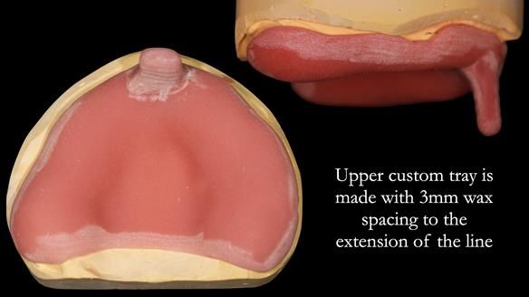 Newsletter 52 Managing Jo’s failing dentition with extractions and Mk 1/Mk 2 complete upper dentures and lower partial dentures FULL PROTOCOL