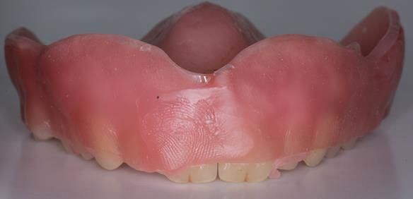 Figure 42 Wax covering the labial aspect of the upper front teeth preventing run of viscogel into the interdental embrasures. This helps speed up clean up of labial surface of the denture. The wax can be pealed off when the viscogel is hard enough.