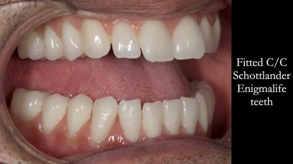 Managing poor implant positioning with complete dentures and Locator attachments - full protocol Newsletter 41