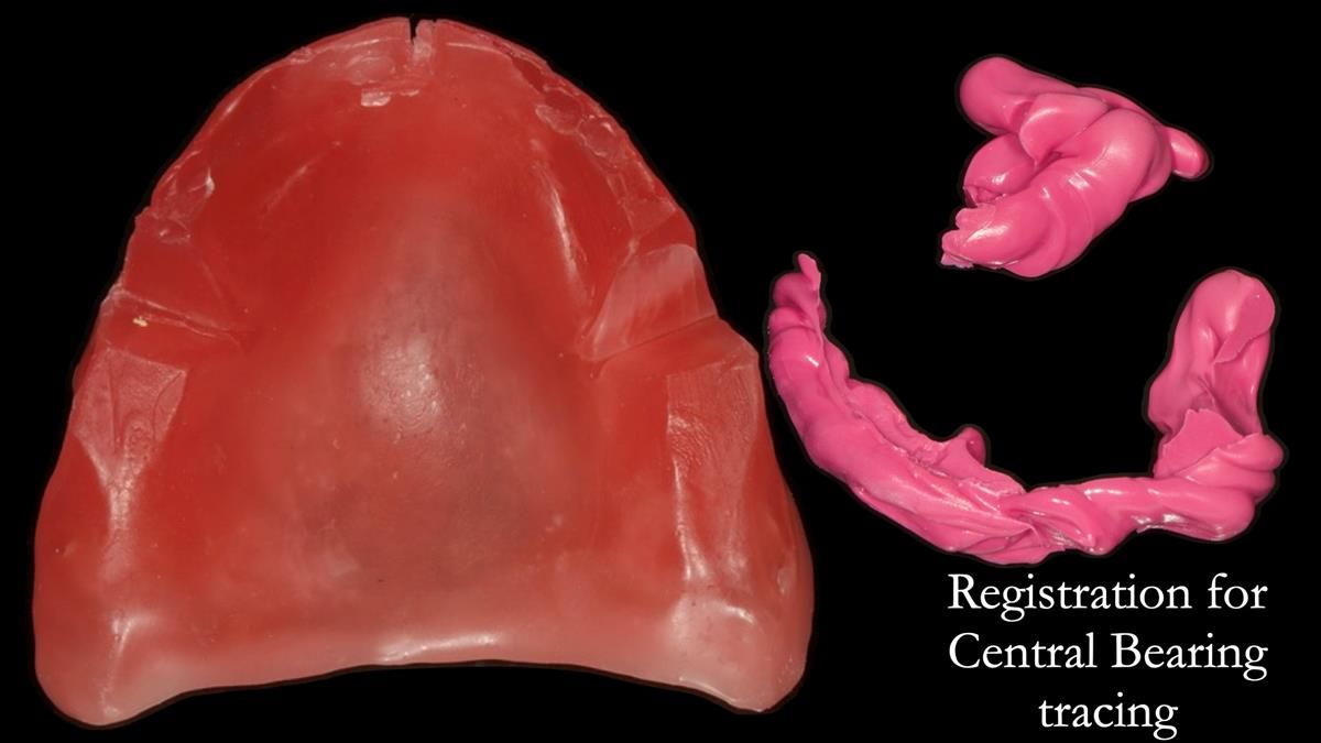 Newsletter 87 – Father Peter: A Partial Denture that needed Minor Miracle