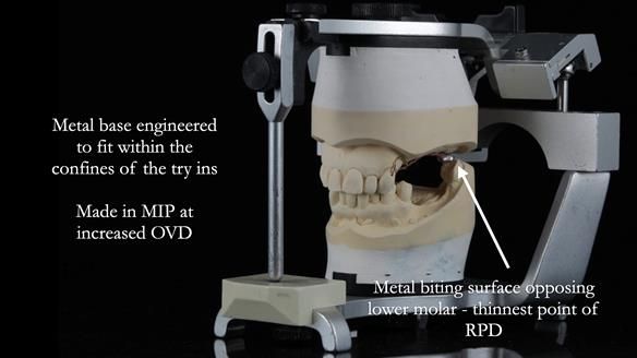 Finlay's Newsletter 60 Sylvia's upper Kennedy Class 2 Mod 1 metal based upper RPD
