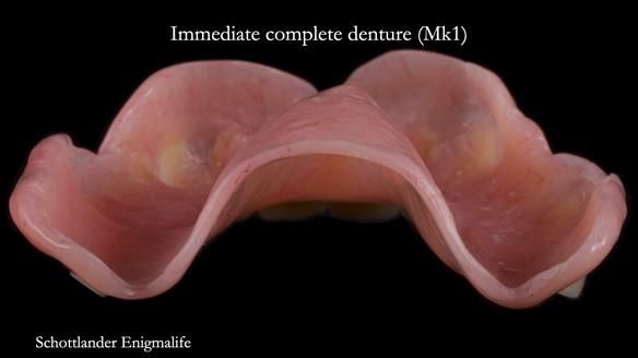 Newsletter 77: Jeremy’s case – immediate complete upper denture