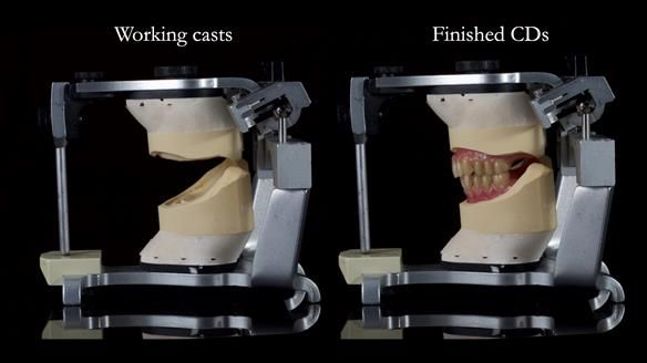 Newsletter 83: Sheila’s Complete Denture Success