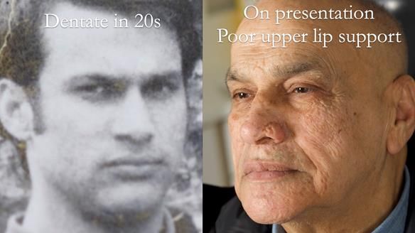 Managing poor implant positioning with complete dentures and Locator attachments - full protocol Newsletter 41