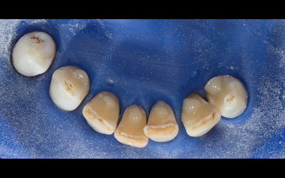 Figure 67 Composite rest seats placed on the lingual of the lower anterior teeth to assist in stabilising and supporting the metal based lower denture