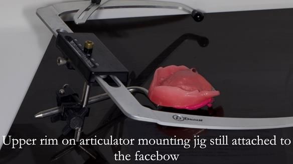 Newsletter 57 showcases the making and fitting process of implant-supported complete dentures for Alisdair