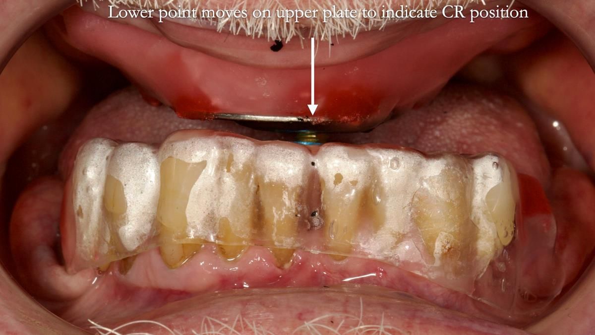 Newsletter 87 – Father Peter: A Partial Denture that needed Minor Miracle