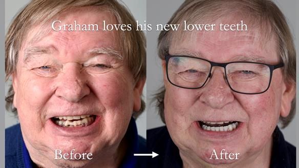 Newsletter 44 - extreme removable prosthodontics – engineering a super-strong and ultra-thin over denture