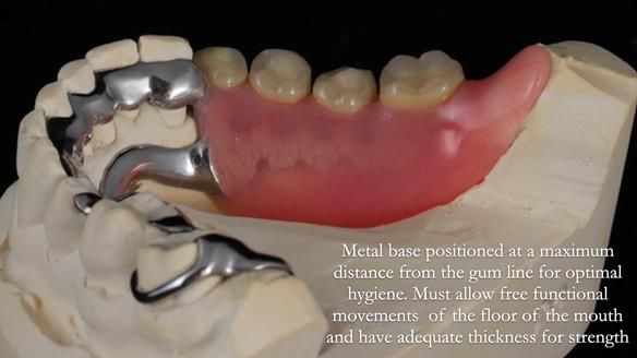 Finlay's Newsletter 61 provision of a lower unilateral free end saddle metal based partial denture for Joyce