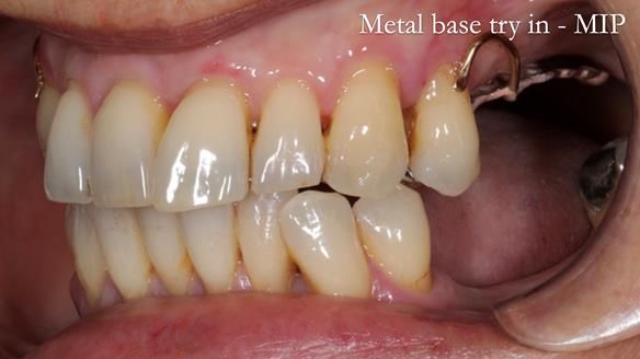 Newsletter 56 showing the making and fitting of a bilateral free end saddle upper removable partial denture (RPD) for patient with pemphigus
