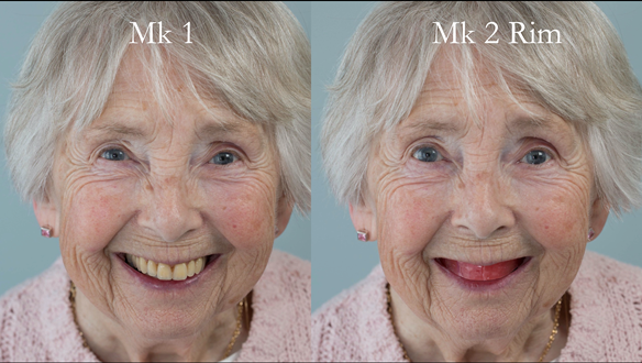 Figure 74 Comparison of Mk 1 denture and Mk 2 rim