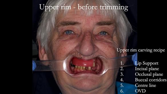 Newsletter 55 Provision of metal based partial dentures for Zephyrine with a repaired cleft lip and palate