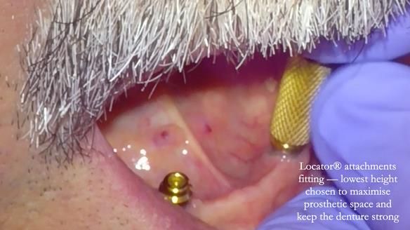 Newsletter 78: What do Clark Gable and a Locator® overdenture have in common?