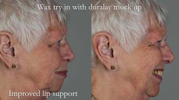 Finlay's Newsletter 59 Ultra hard partial dentures made for Gill