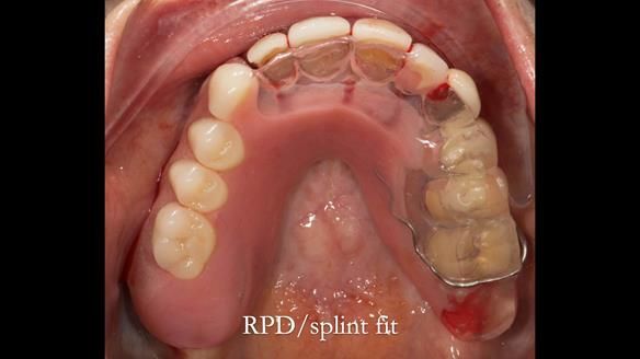 Newsletter 51 Managing Anne’s failing dentition with distal extension base RPD/Splint FULL PROTOCOL