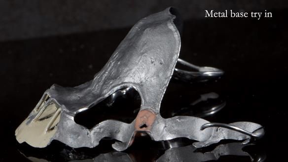 Newsletter 81 - Pam’s Story — how a partial denture changed her life (+ live walkthrough this Thursday)