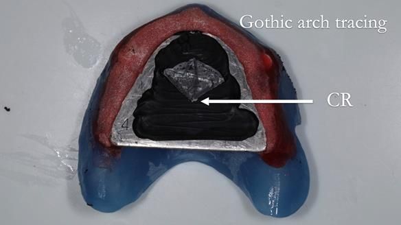Newsletter 57 showcases the making and fitting process of implant-supported complete dentures for Alisdair