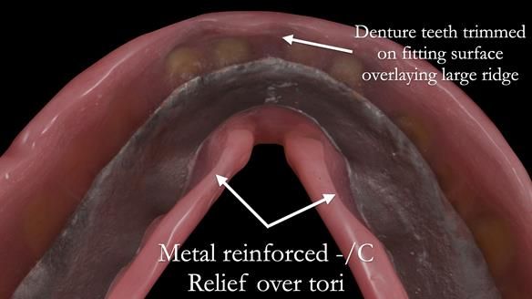 Newsletter 53 showing the making and fitting of ultra life-like dentures for Valena