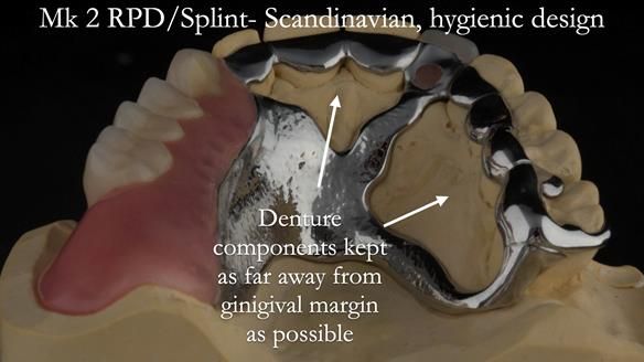 Newsletter 51 Managing Anne’s failing dentition with distal extension base RPD/Splint FULL PROTOCOL