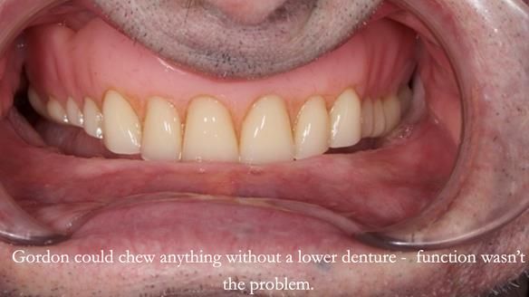 Newsletter 80 - Gordon’s dentures: the one case in 1,000 where my technique failed