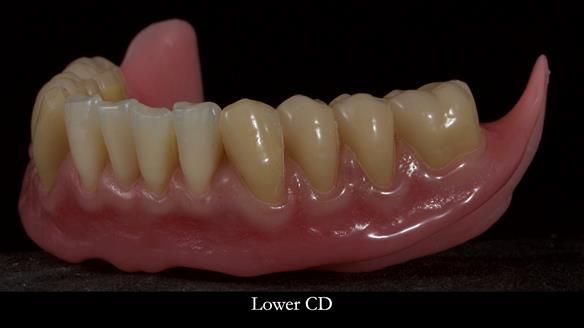 Newsletter 83: Sheila’s Complete Denture Success
