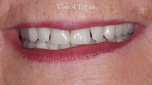 Replacing Madeline’s Complete denture FULL PROTOCOL