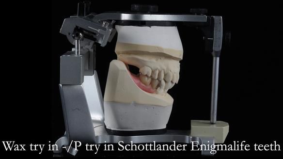 Newsletter 54 case presentation upper complete denture and lower Scandinavian designed hygienic partial denture for David