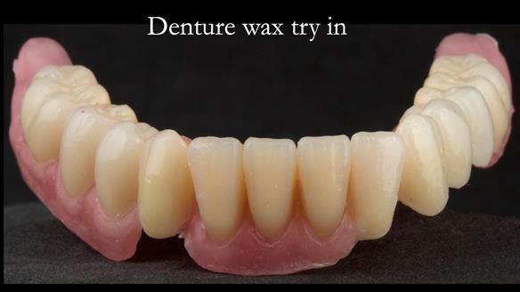 Newsletter 76: Jackie’s case – Telescopic overdenture & precision RPD (the tricky truth!)