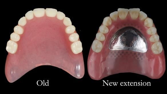 Managing poor implant positioning with complete dentures and Locator attachments - full protocol Newsletter 41