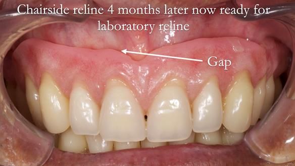Finlay's Newsletter 62 provision of extractions and metal based complete dentures for Rafique