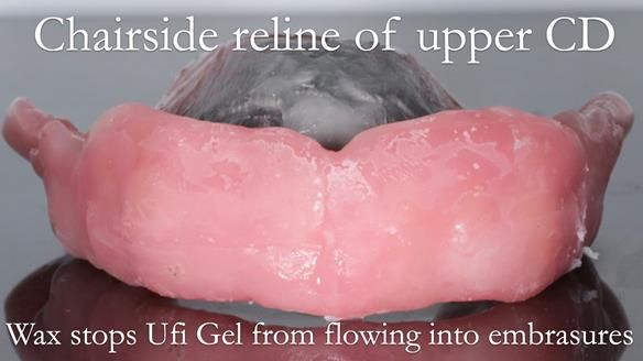 Finlay's Newsletter 62 provision of extractions and metal based complete dentures for Rafique