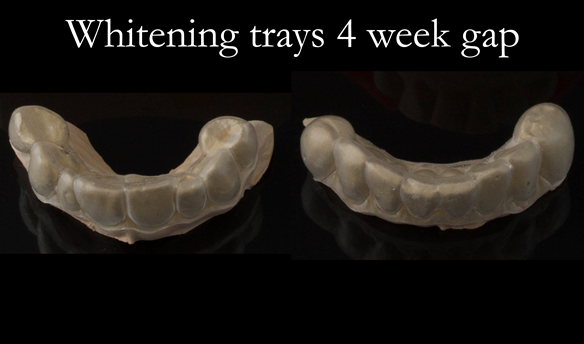 Figure 40 Night time tooth whitening carried out with 10% Carbamide Peroxide over 2 weeks.