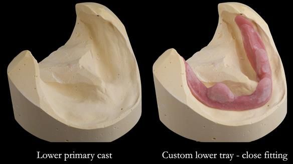 Replacing Madeline’s Complete denture FULL PROTOCOL