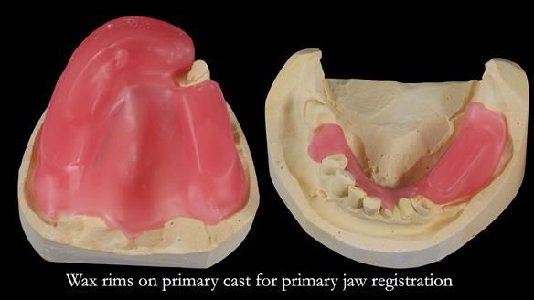 Newsletter 55 Provision of metal based partial dentures for Zephyrine with a repaired cleft lip and palate