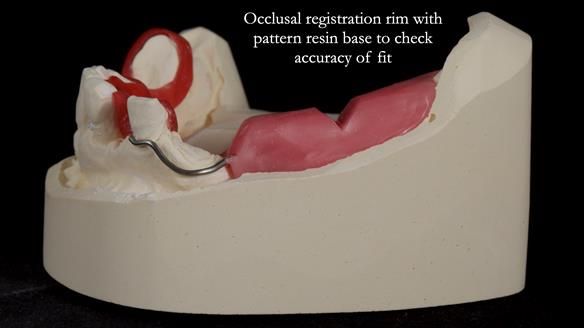 Newsletter 55 Provision of metal based partial dentures for Zephyrine with a repaired cleft lip and palate