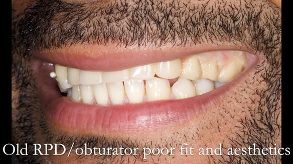 Acrylic based partial denture/obturator had poor, retention and support Obturator section was in poor condition. The Adams clasp were causing inflammation of the gingival margins. The clasp on the UR3 was visible resulting in poor appearance. Reduced lip