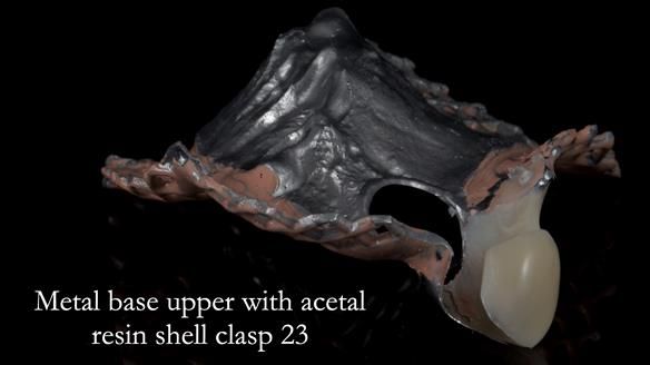 Newsletter 55 Provision of metal based partial dentures for Zephyrine with a repaired cleft lip and palate